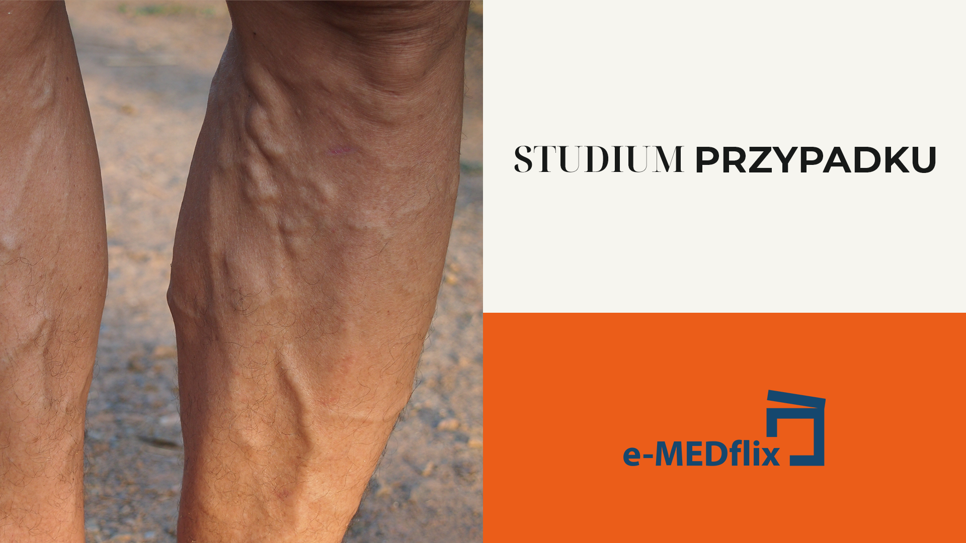 Przewlekła Niewydolność Żylna w pigułce – diagnostyka i leczenie_ cs