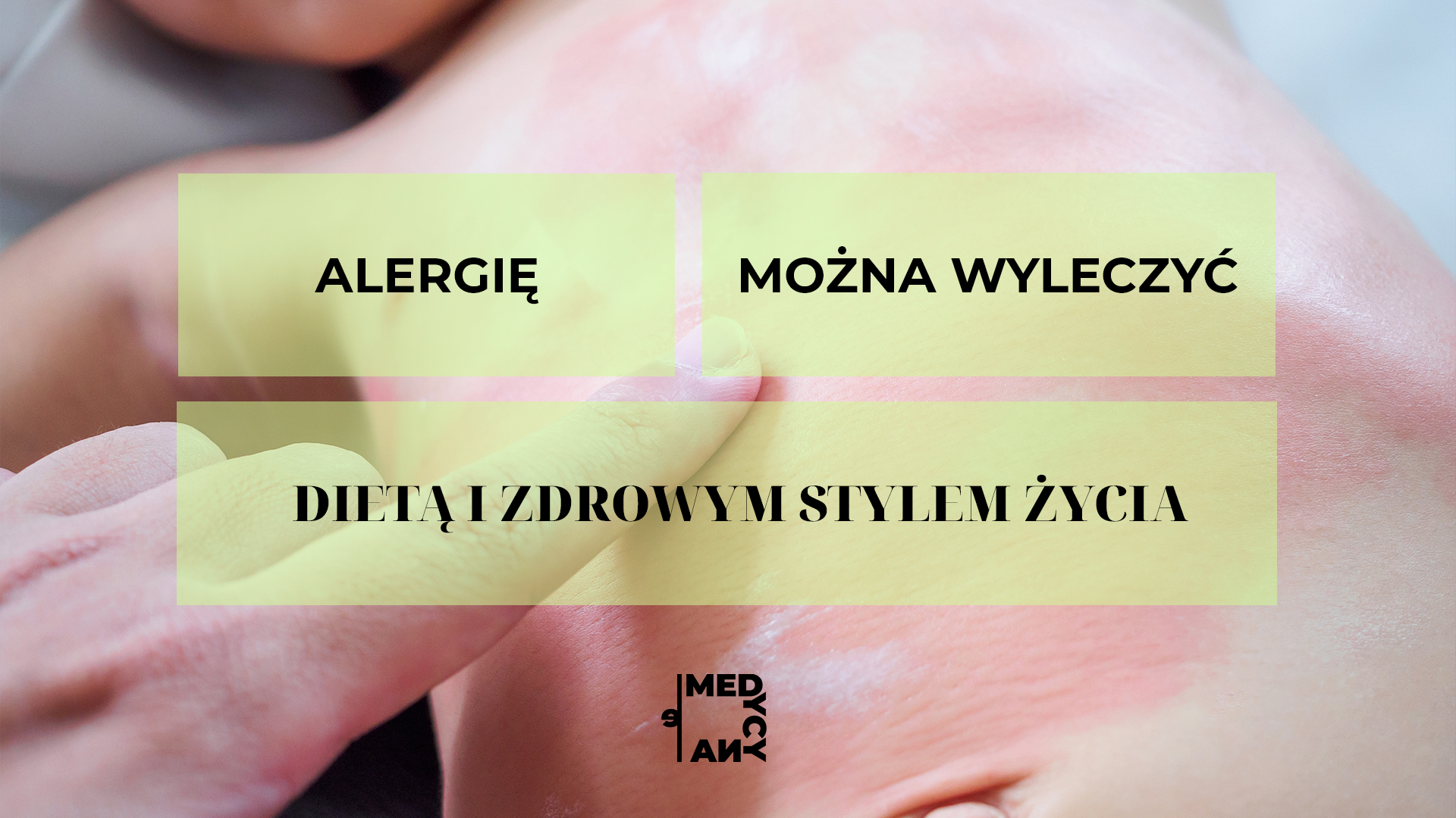  Alergię można wyleczyć dieta i zdrowym stylem zycia