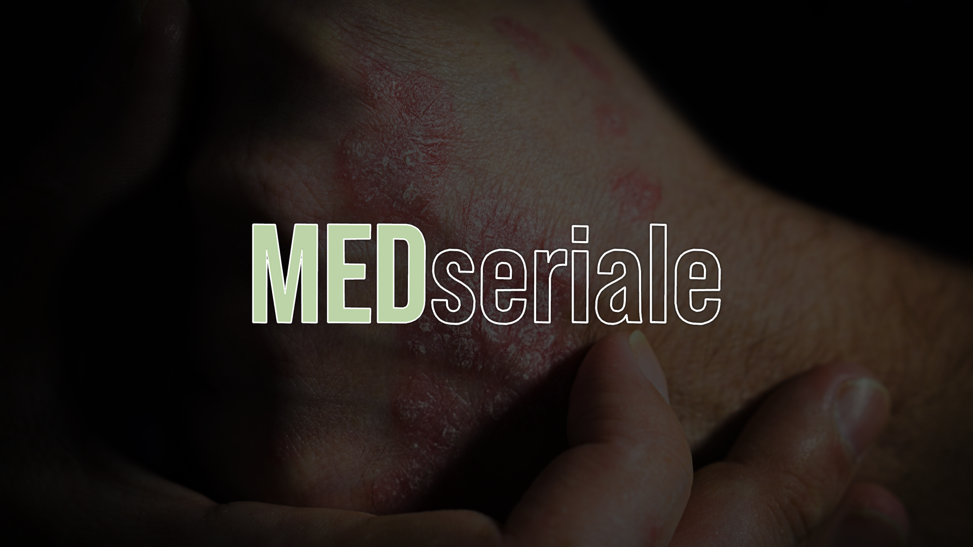 Nowoczesne metody leczenia – od maści po terapię biologiczną.  