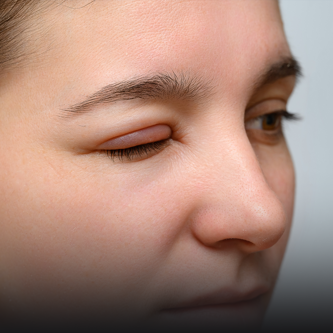 Wielowymiarowe Oblicza HAE - szkolenie dla lekarz.png