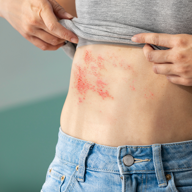 Nowoczesne Terapie 2025 – Nowoczesna profilaktyka półpaśca u dorosłych po 50 rż- skuteczność, bezpieczeństwo i zastosowanie kliniczne.png