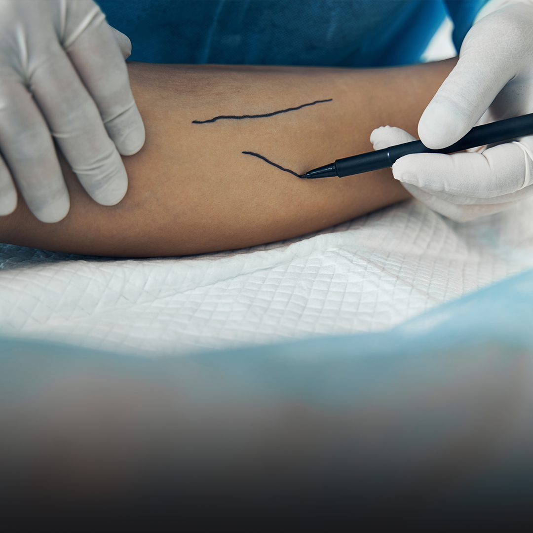 ABC przewlekłej niewydolności żylnej – w świetle rekomendacji dermatologicznych.png