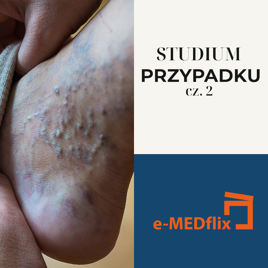 e-medflix_żyły w lecie_CS2.png
