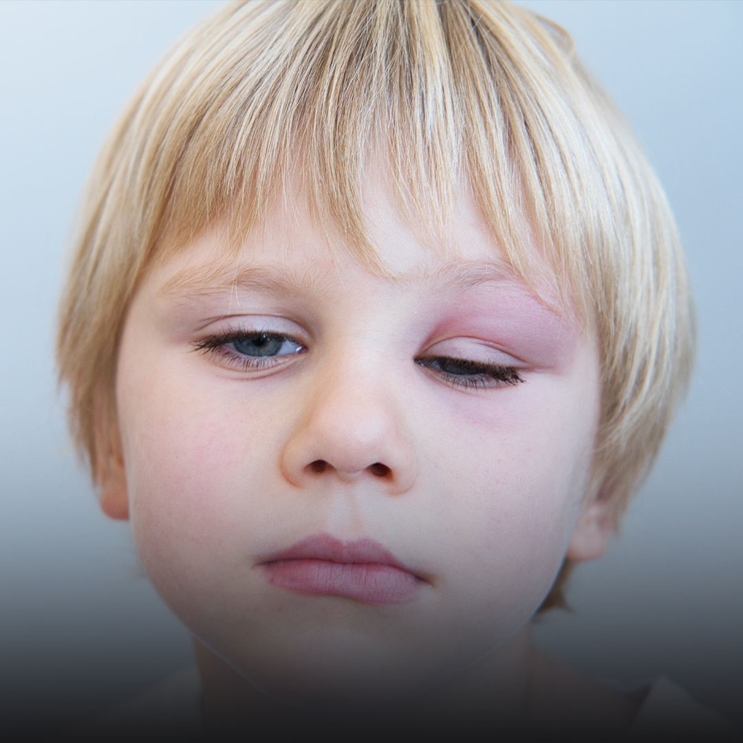 anafilaksja okiem praktyka.png