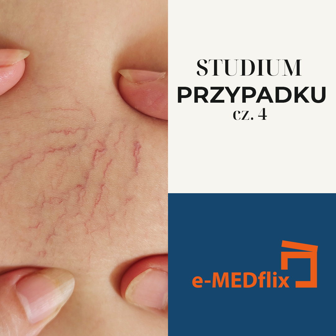 e-medflix_żyły w lecie_CS4.png