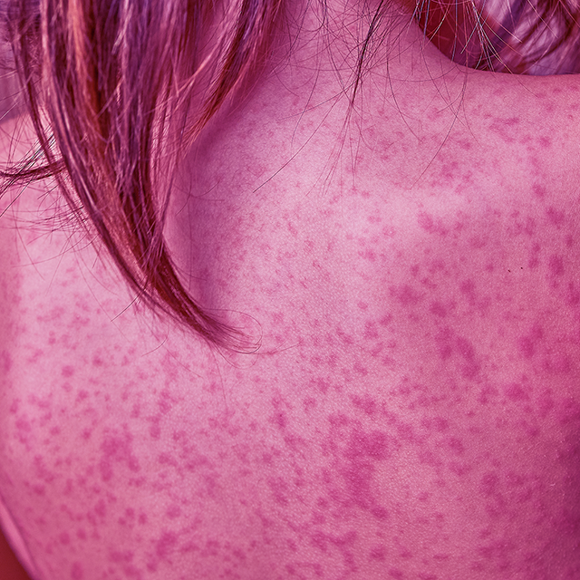 Atopowe zapalenie skóry 3.0.png