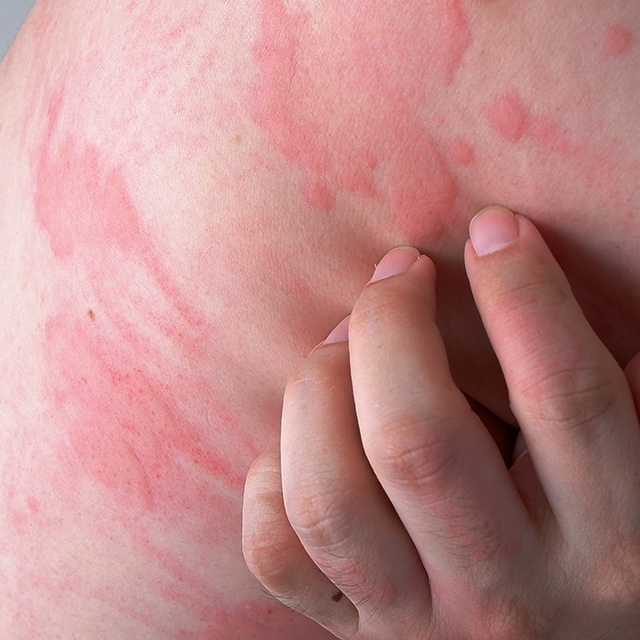 Nowoczesne Terapie 2025 – Pokrzywka przewlekła w świetle najnowszych doniesień_POZ.png